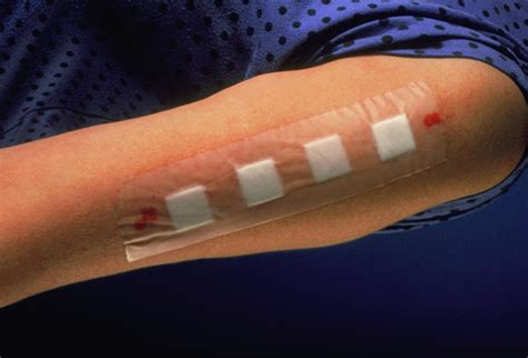 Diagram illustrating patch testing on the inner arm