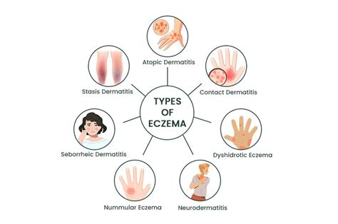 Diagram illustrating the different types of eczema and their common locations on the body