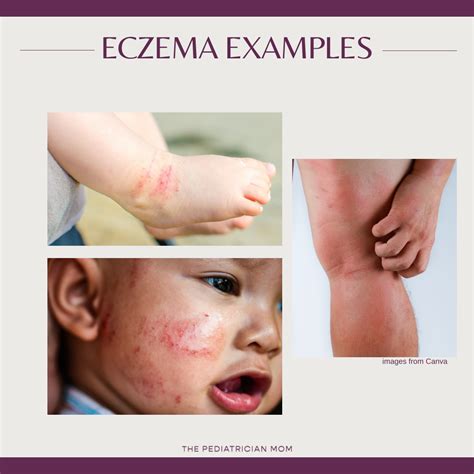 Illustrations of eczema presentation in infants, toddlers, school-aged children, and adults