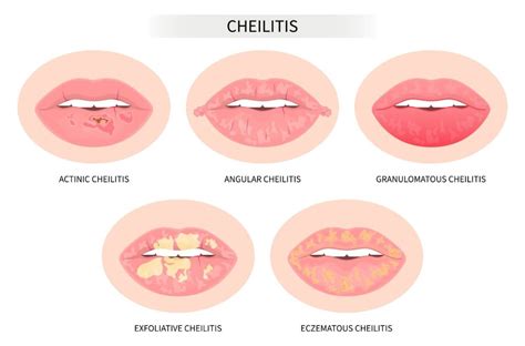 Illustration showing the corners of the mouth where angular cheilitis typically appears.