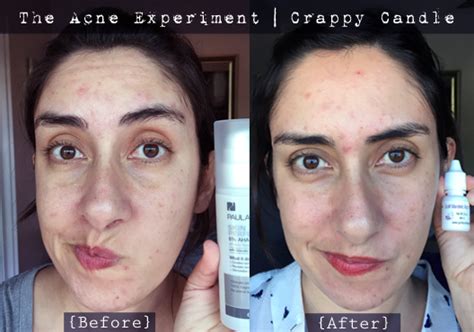 before and after photos showing skin improvement after using mandelic acid products