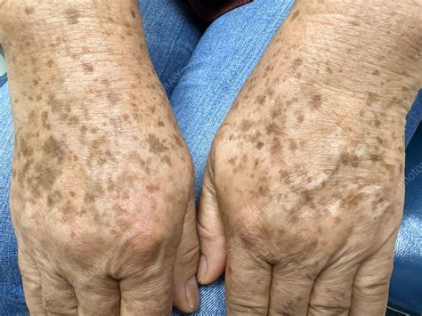 Close-up photograph of multiple solar lentigines (age spots) on the back of a hand.