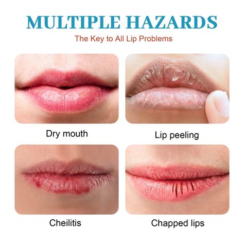 Diagram illustrating how certain medications can lead to dry lips.