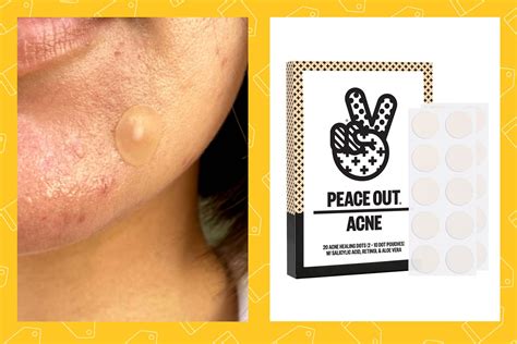 Split image showing a pimple patch on an open pimple (effective) and a closed pimple (less effective).