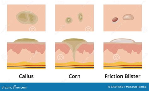 Illustration showing micro-abrasions on the skin caused by friction from a rough pillowcase.