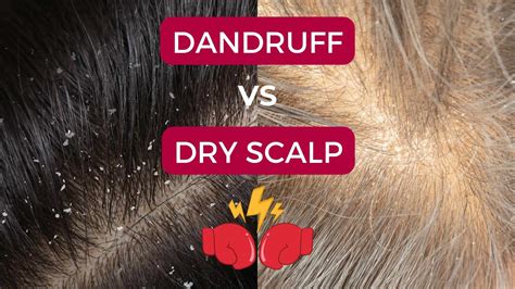 Illustration showing the difference between dandruff flakes and dry scalp flakes.