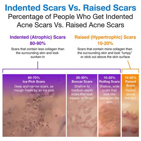 Diagram illustrating the difference between atrophic (indented) and hypertrophic (raised) acne scars.