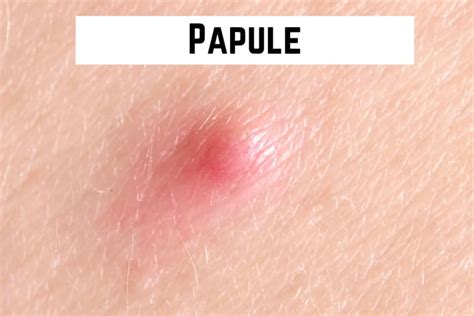 Close-up image of a single inflamed papule on the skin.