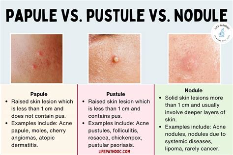 Infographic comparing papules, pustules, nodules, and cysts, highlighting their appearance and depth in the skin.