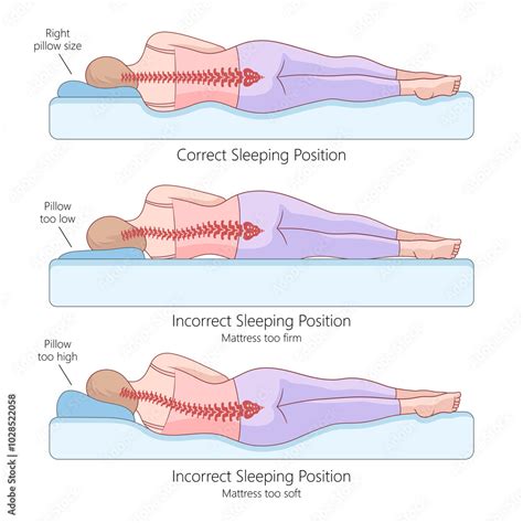 Illustration showing the effect of side sleeping on chest skin compression.