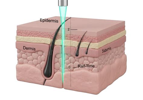 Diagram illustrating how different laser treatments work on skin layers.