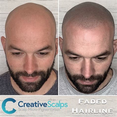 A collage of before and after photos showcasing Scalp Micropigmentation results for men and women with various types of hair loss.