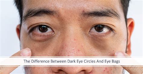 Diagram illustrating the difference between dark circles and under-eye bags