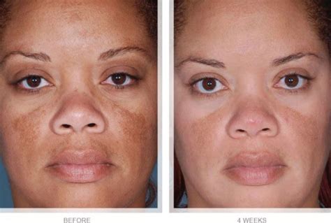 Before and after images of skin treated with alpha arbutin, showing reduction in dark spots and hyperpigmentation.