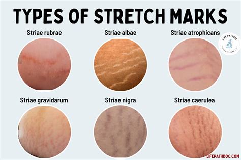Illustration showing the different colors of new stretch marks: bright pink, red, blue, black, or purple.