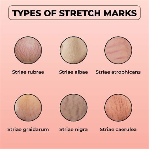 Infographic illustrating the layers of skin and how stretching leads to striae.