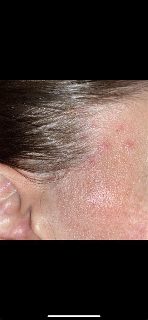 Illustration showing common areas affected by hair dye rash: hairline, ears, and neck.
