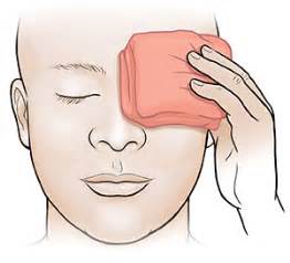Diagram illustrating how to apply a warm compress to an eyelid.
