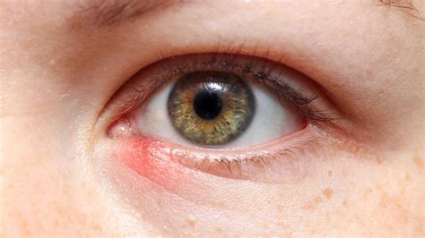 Close-up photograph of a stye on an eyelid.