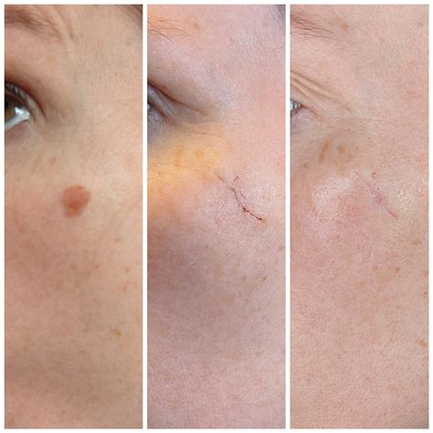 Close-up image of a well-healed mole removal scar