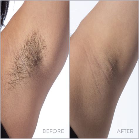 Split image: Left side shows underarm hair before laser treatment, right side shows smooth, hair-free underarm skin after treatment.