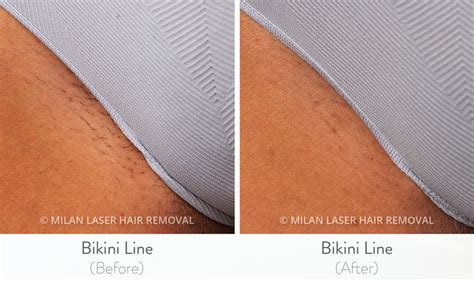 Split image: Left side shows bikini line hair before laser treatment, right side shows smooth, hair-free bikini line area after treatment.