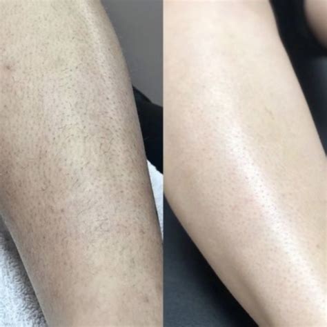Split image: Left side shows hair on legs before laser treatment, right side shows smooth, hair-free leg skin after treatment.
