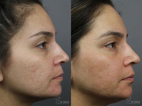 Split image: Left side shows hair on arms before laser treatment, right side shows smoother arm skin after treatment.
