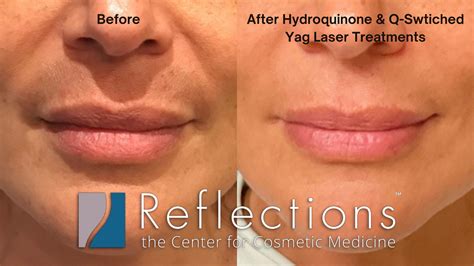 Split image: Left side shows facial hair (e.g., upper lip) before laser treatment, right side shows smooth facial skin after treatment.