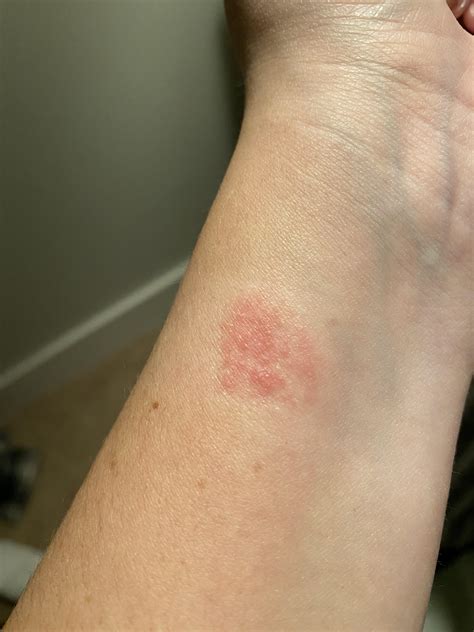 Illustration of a red, irritated wrist with an Apple Watch band
