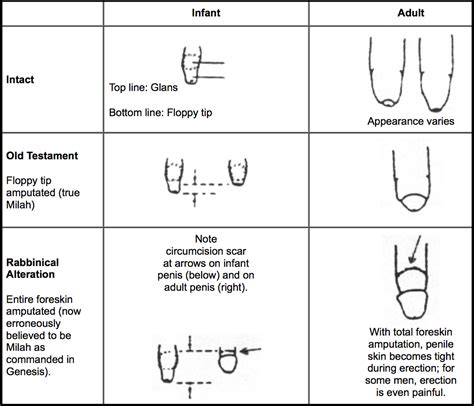 Illustration comparing a normal circumcision result with an incomplete circumcision showing excess foreskin.