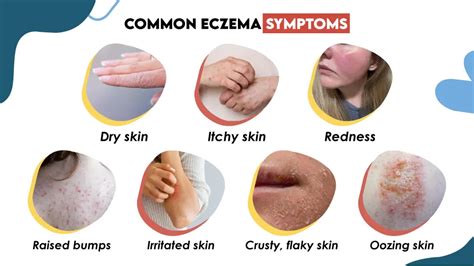 Illustration of the eye area with common eczema symptoms like redness and dryness