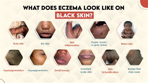 Infographic showing the different appearances of eczema on light and dark skin tones around the eyes