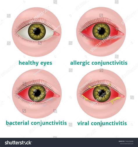 Side-by-side comparison of symptoms for Blepharitis and Allergic Conjunctivitis