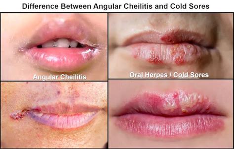 Side-by-side comparison of the visual characteristics of cold sores and angular cheilitis.