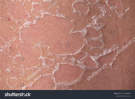 Close-up image of skin peeling after a sunburn, illustrating the texture and appearance.