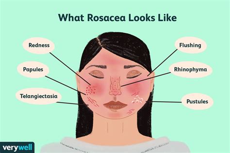 Infographic illustrating the common symptoms of rosacea: facial redness, flushing, visible blood vessels, bumps, and pimples.