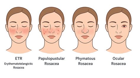 Diagram comparing and contrasting ETR and Papulopustular Rosacea symptoms.