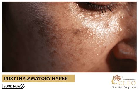 Infographic detailing the steps for managing post-inflammatory hyperpigmentation, including sun protection and topical treatments.