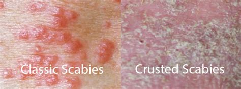 Image comparing typical scabies rash with crusted scabies plaques