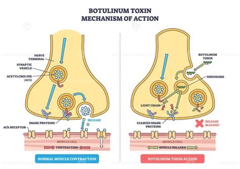Diagram showing the mechanism of Botox action on sweat glands, blocking nerve signals.