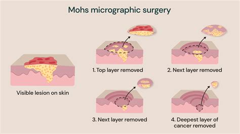 A diagram illustrating the Mohs surgery technique, showing layers of tissue removal and microscopic examination.