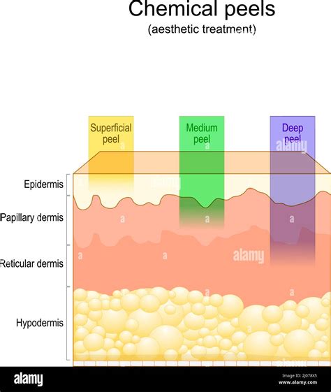 Illustration showing the layers of the skin and how a chemical peel affects them.