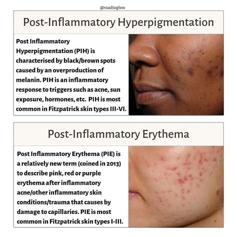 Infographic comparing different skin types and their susceptibility to post-inflammatory hyperpigmentation after peels.