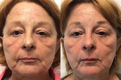 Split image showing before and after photos of a patient treated with a TCA peel for wrinkles and age spots.