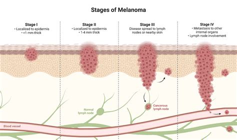 Diagram illustrating the stages of melanoma progression