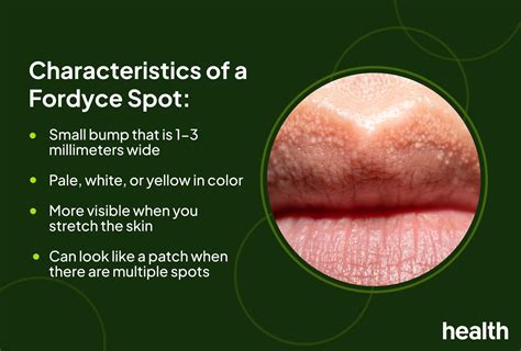 Illustration showing Fordyce spots on the lips and inside of the cheek.