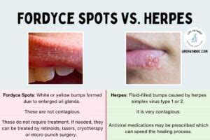 Diagram illustrating the difference in appearance and cause between Fordyce spots, herpes blisters, and genital warts.