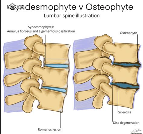Illustration showing a cross-section of a vertebra with an osteophyte and end-plate sclerosis