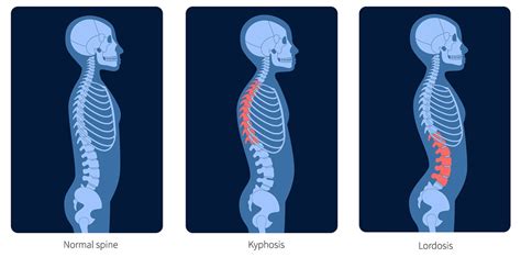 Diagram illustrating the normal curvature of the spine versus a spine with reduced lumbar lordosis